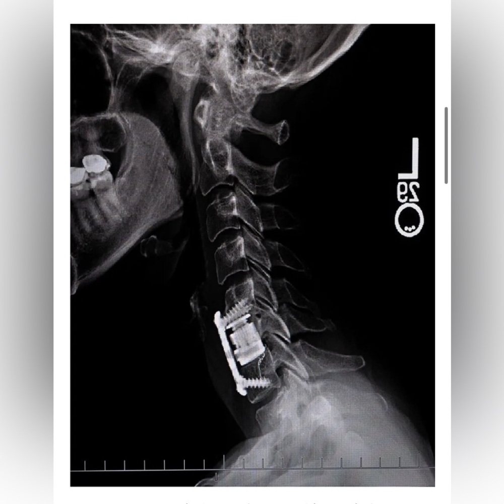 X-Ray Image of Cervical Spine w/ Cage Hardware After Corpectomy Surgery